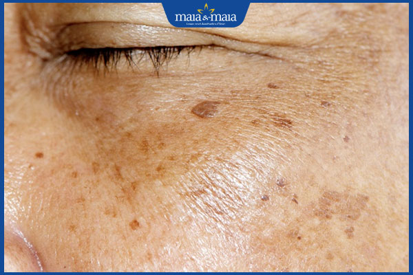 Đốm nâu trên gò má do đâu? Có loại bỏ triệt để được không? 2 đốm nâu lão hóa