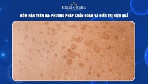 đốm nâu trên da