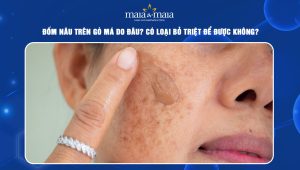 đốm nâu trên gò má