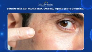 đốm nâu trên mặt