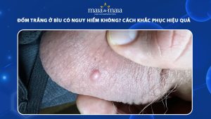 đốm trắng ở bìu