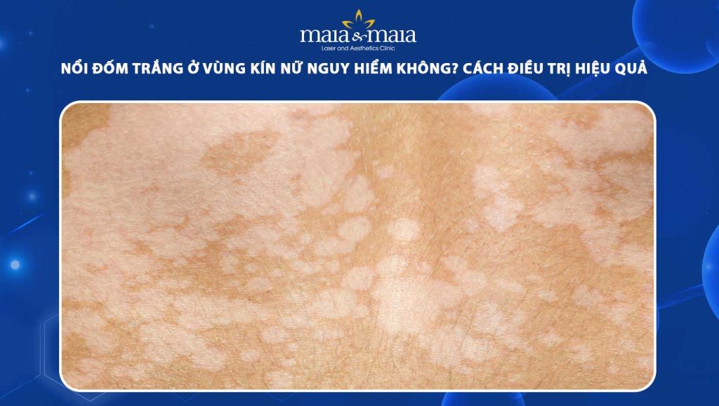 đốm trắng ở vùng kín nữ