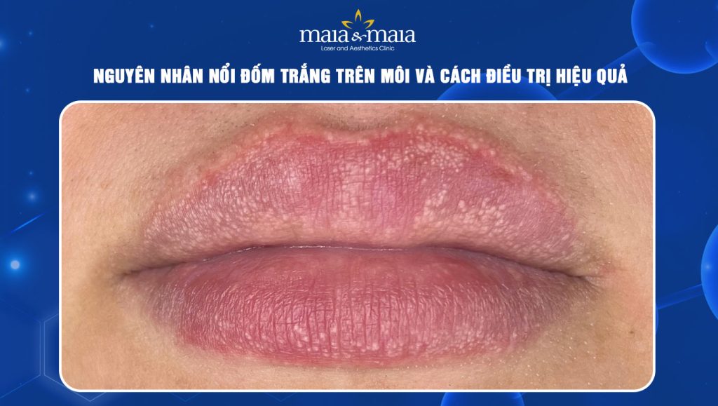 Nguyên nhân nổi đốm trắng trên môi và cách điều trị hiệu quả 1 đốm trắng trên môi