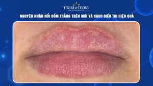 đốm trắng trên môi
