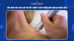 đốt mụn thịt bao lâu thì hết thâm