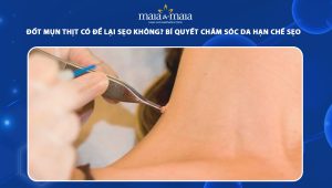 đốt mụn thịt có để lại sẹo không