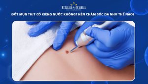 đốt mụn thịt có kiêng nước không