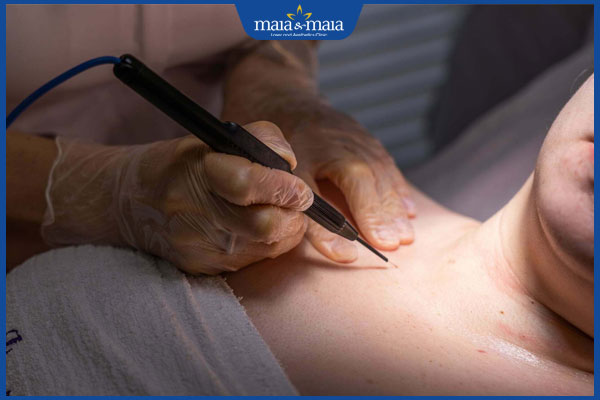 đốt mụn thịt ở ngực