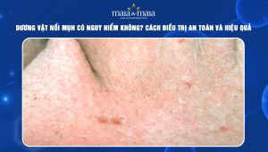 Dương vật nổi mụn