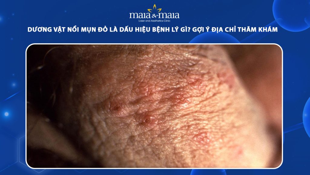 Dương vật nổi mụn đỏ là bệnh lý gì? Địa chỉ thăm khám uy tín 1 dương vật nổi mụn đỏ