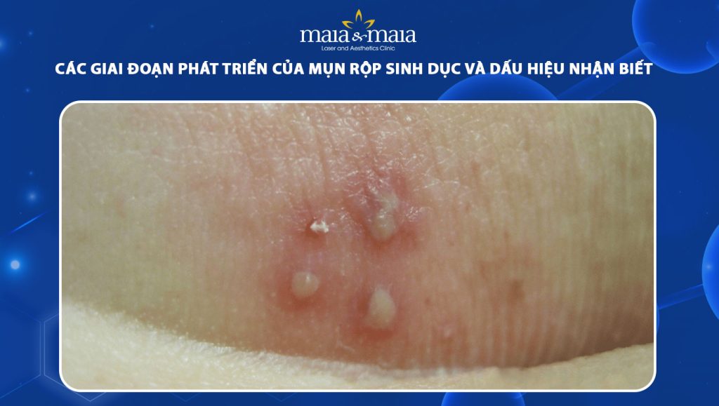 Giai đoạn phát triển của mụn rộp sinh dục và cách nhận biết 1 giai đoạn phát triển của mụn rộp sinh dục