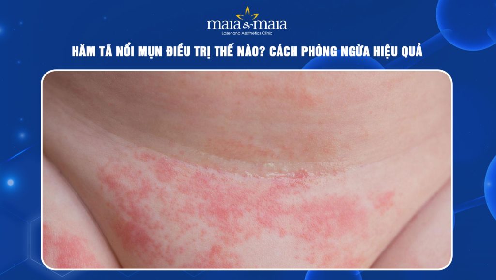 hăm tã nổi mụn