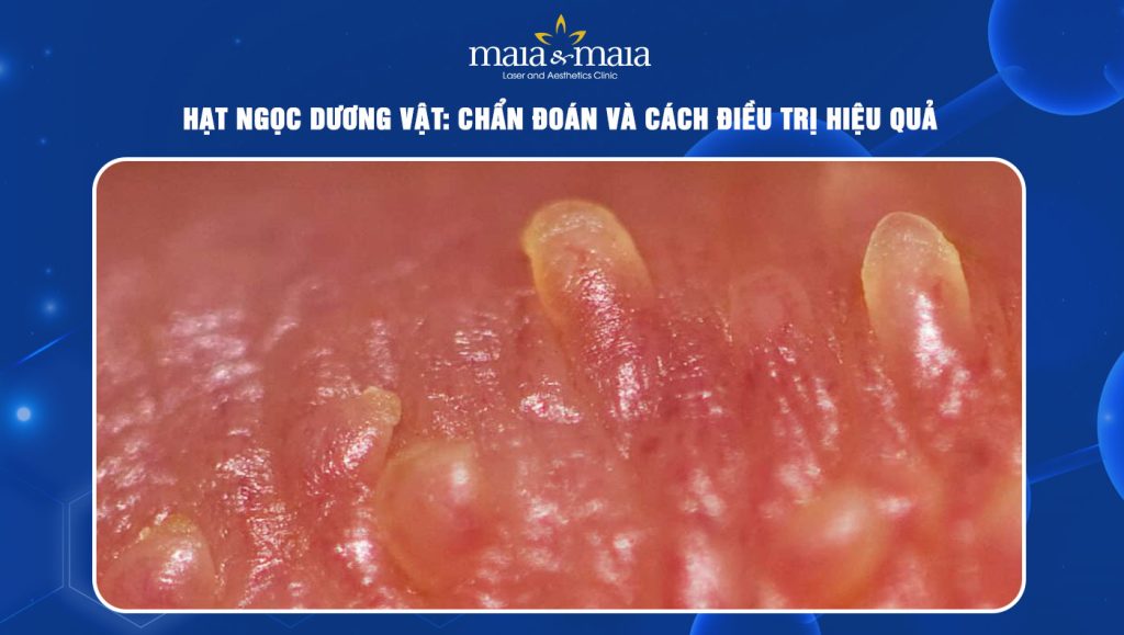 Hạt ngọc dương vật: Nguyên nhân, dấu hiệu & cách xử lý 1 hạt ngọc dương vật