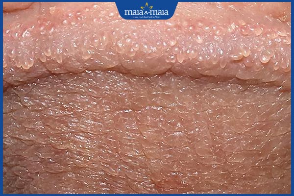 Hạt ngọc dương vật: Nguyên nhân, dấu hiệu & cách xử lý 2 hình ảnh hạt ngọc dương vật