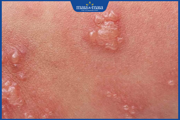 hình ảnh mụn rộp sinh dục nữ