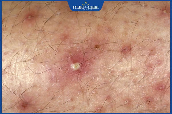 Mụn rộp sinh dục nam có nguy hiểm không? Điều trị ở đâu tốt? 4 hình ảnh mụn rộp sinh dục ở nam giới