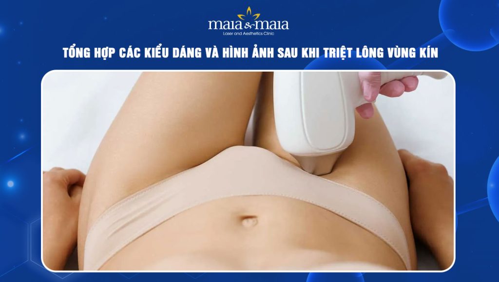 hình ảnh sau khi triệt lông vùng kín