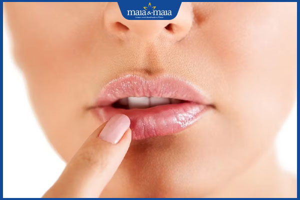 Mụn rộp môi có để lại sẹo không? Làm sao để hạn chế sẹo? 3 không chạm vào mụn rộp ở môi