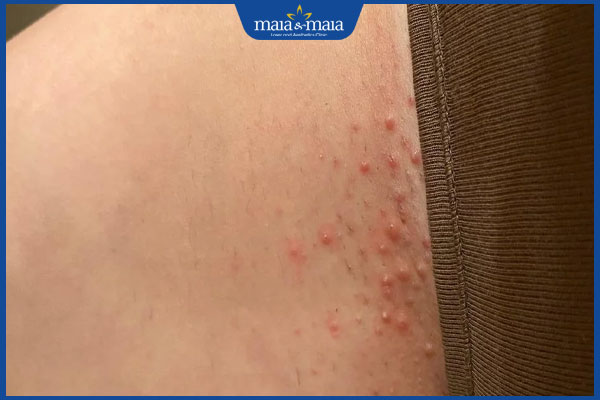 Triệt lông vùng kín có ảnh hưởng gì không? Thực hư ra sao? 2 kích ứng sau triệt lông vùng kín