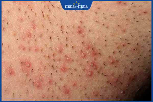 kích ứng vùng kín nam