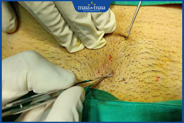 kỹ thuật cấy lông mu vùng kín