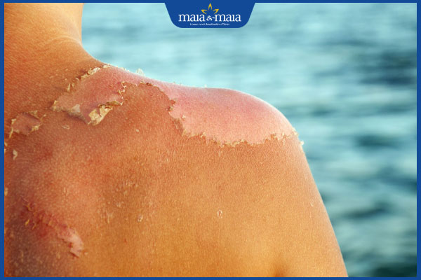 làn da bị cháy nắng