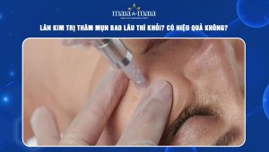 Lăn kim trị thâm mụn