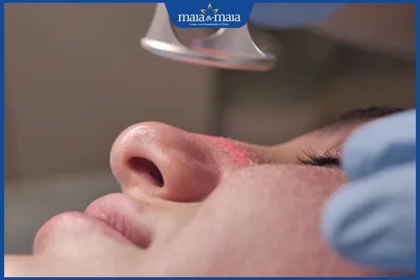 laser trị mụn gạo