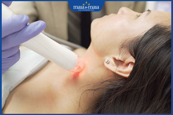 laser vùng cổ
