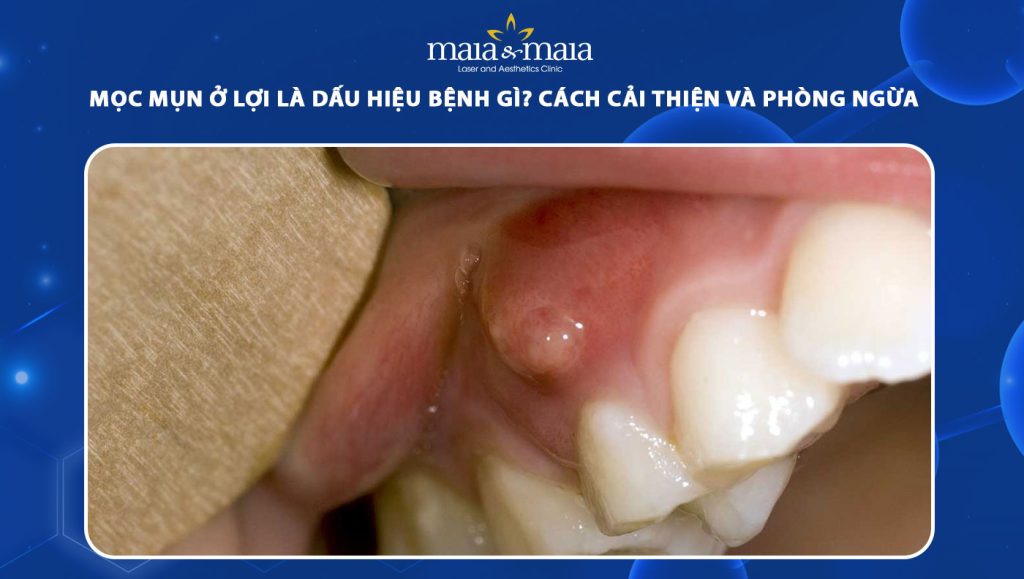 mọc mụn ở lợi