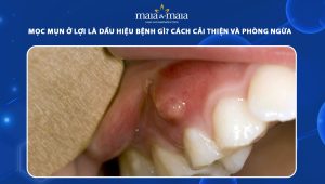 mọc mụn ở lợi