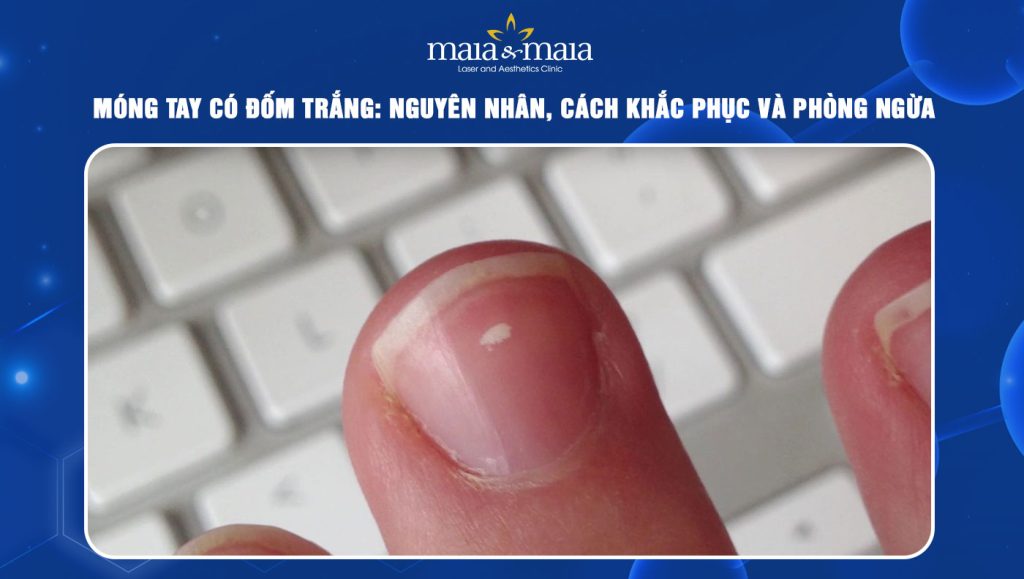 Móng tay có đốm trắng
