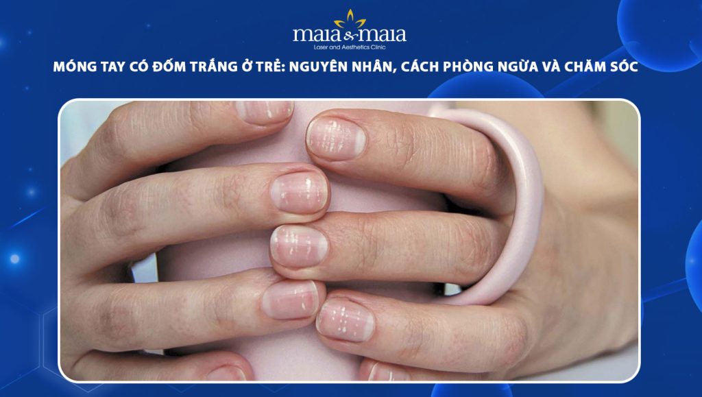 Móng tay có đốm trắng ở trẻ: Nguyên nhân và cách phòng ngừa 1 móng tay có đốm trắng ở trẻ
