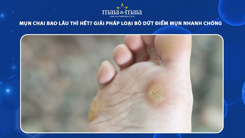 Mụn chai bao lâu thì hết? Giải pháp loại bỏ dứt điểm mụn 1 mụn chai bao lâu thì hết