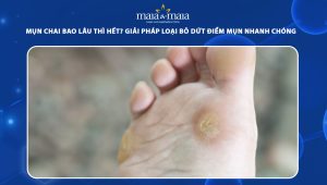 mụn chai bao lâu thì hết