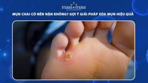 mụn chai có nên nặn không