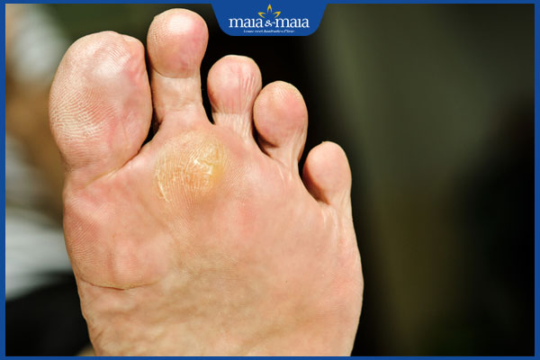 Mụn chai có nên nặn không? Gợi ý giải pháp xóa mụn hiệu quả 3 mụn chai không tự hết