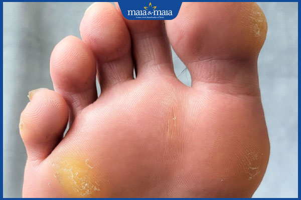 Mụn chai có nên nặn không? Gợi ý giải pháp xóa mụn hiệu quả 2 mụn chai ở chân