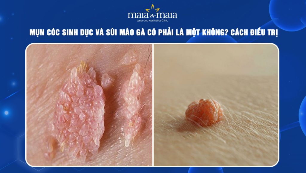 Mụn cóc sinh dục và sùi mào gà có phải là một không? 1 Mụn cóc sinh dục và sùi mào gà