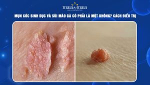 Mụn cóc sinh dục và sùi mào gà