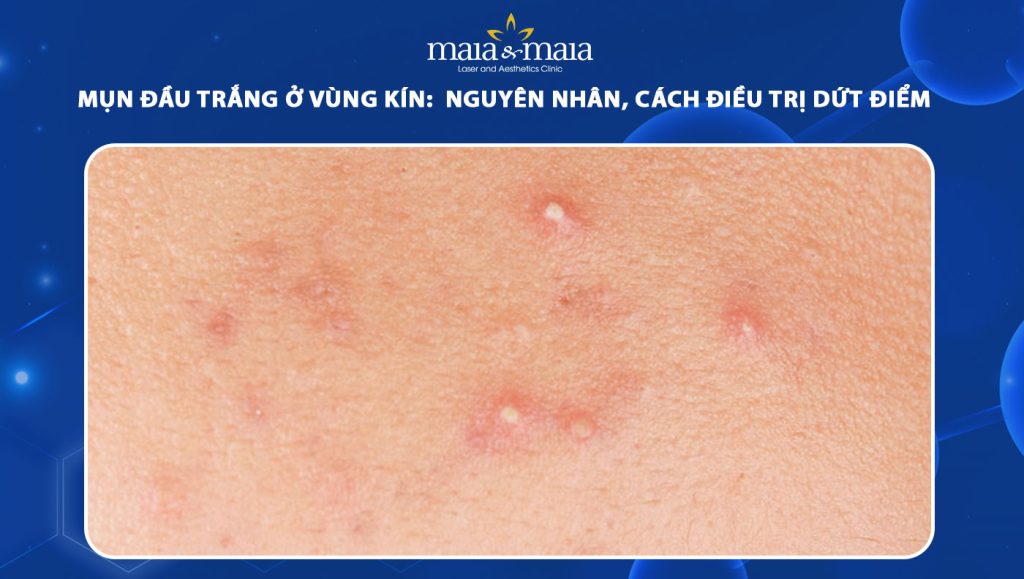 mụn đầu trắng ở vùng kín