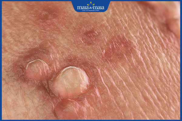 mụn do bệnh lậu