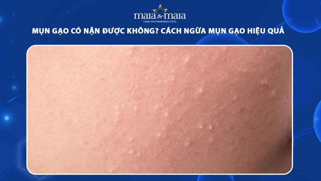mụn gạo có nặn được không