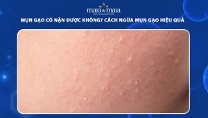 mụn gạo có nặn được không