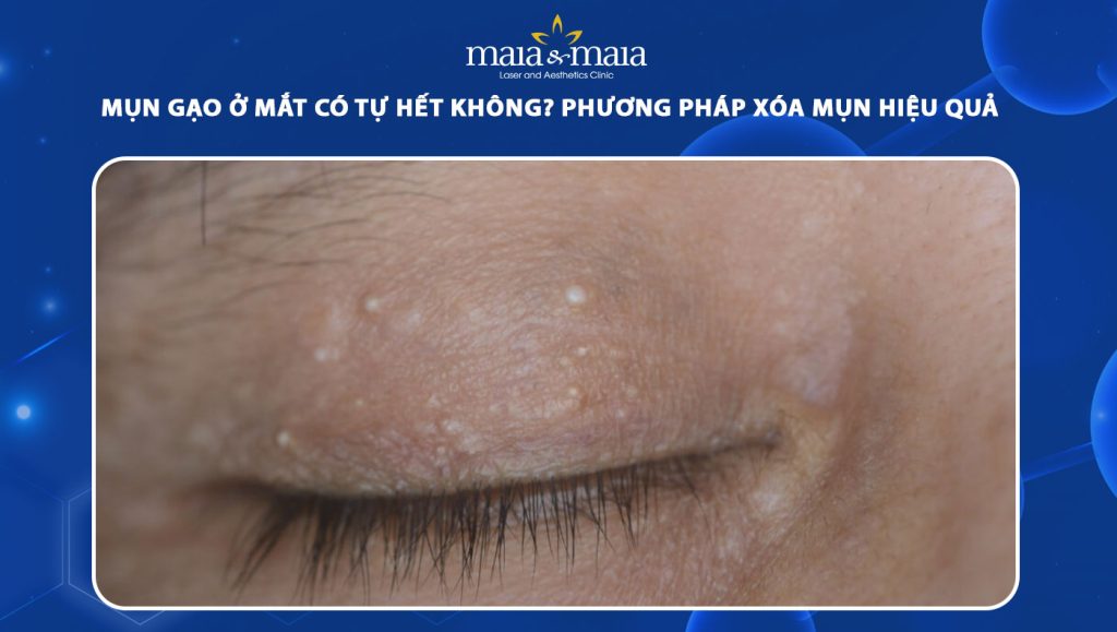 Mụn gạo ở mắt có tự hết không? Phương pháp xóa mụn hiệu quả 1 mụn gạo ở mắt