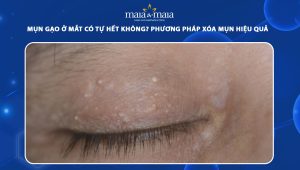 mụn gạo ở mắt