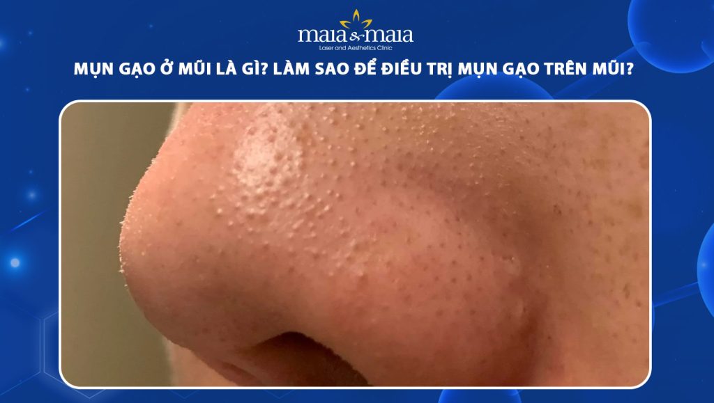 Mụn gạo ở mũi là gì? Cách điều trị mụn gạo trên mũi dứt điểm 1 mụn gạo ở mũi