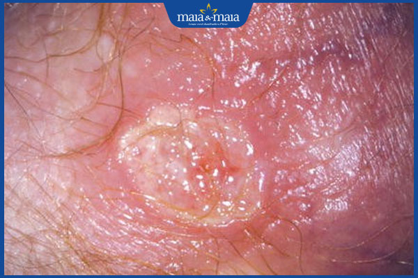 mụn gây lở loét vùng kín