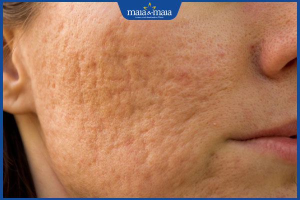 mụn gây sẹo trên mặt