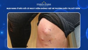 mụn nang ở đầu gối